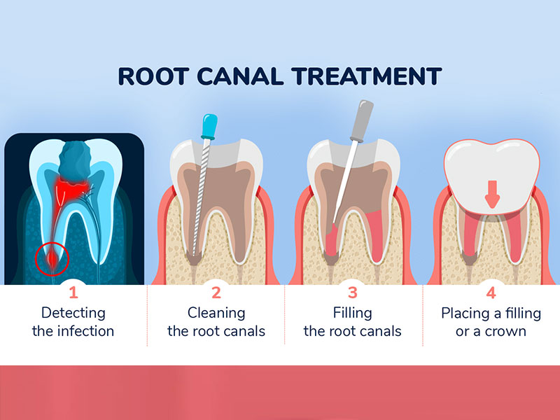 Root Canal Treatment in Bawana Delhi